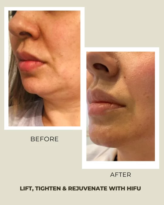 HIFU Treatment