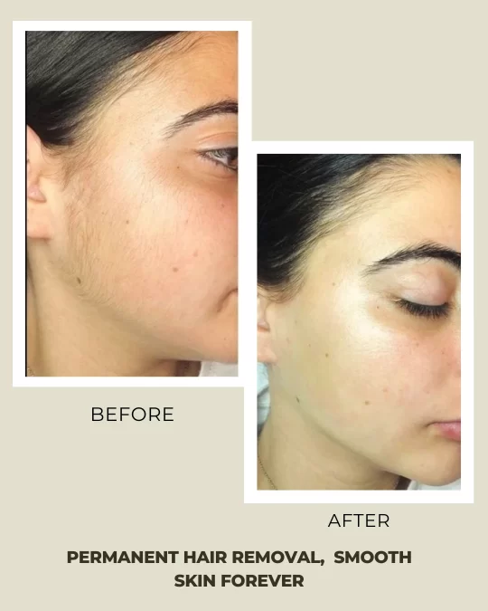 Laser Hair Removal